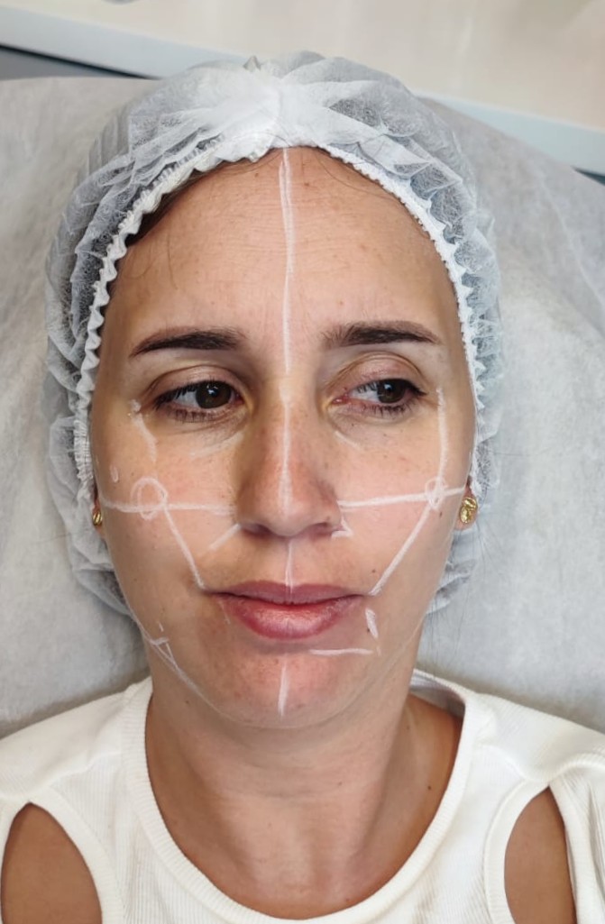 imagen que representa y simboliza bioestimulacion de colageno y refuerza el concepto del contenido Bioestimulación de Colágeno