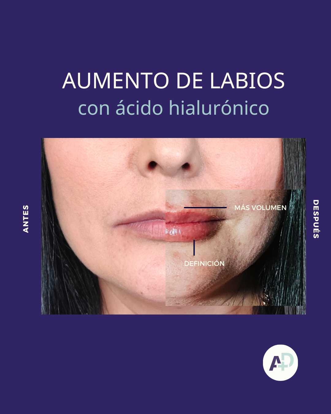 imagen que representa y simboliza perfilamiento de labios y refuerza el concepto del contenido Perfilamiento de Labios