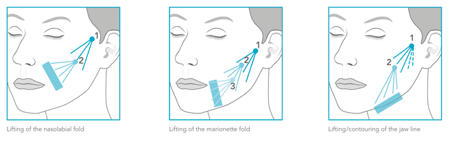 imagen que representa y simboliza bioestimulacion de colageno y refuerza el concepto del contenido Bioestimulación de Colágeno